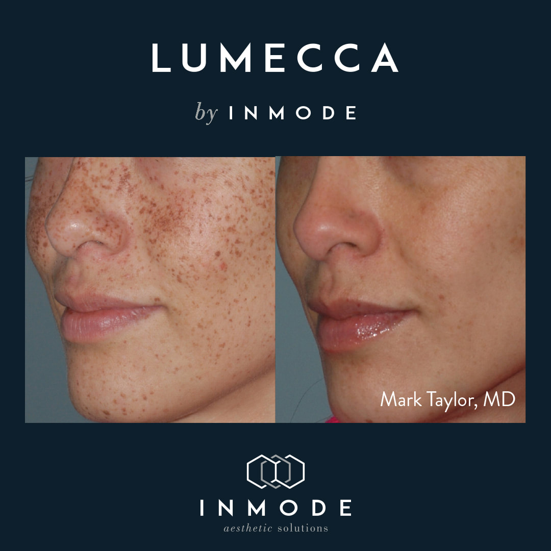 Before and after results of the Lumecca treatment