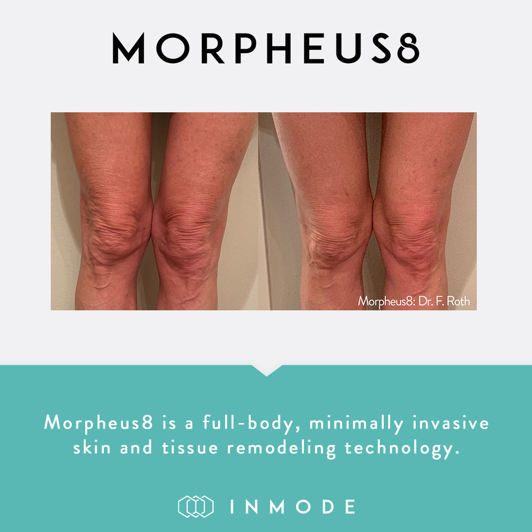 Advertisement for Morpheus8 displaying before and after results