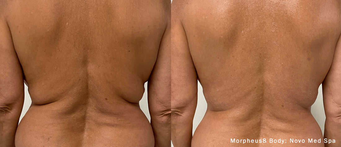 Before and after results from the Morpheus8 treatment