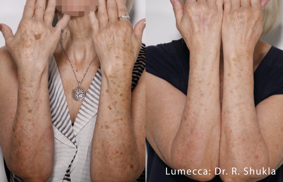 Before and after results of the Lumecca treatment